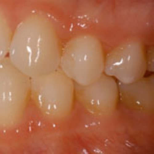 Implant uncoverage in functional areas - basic considerations